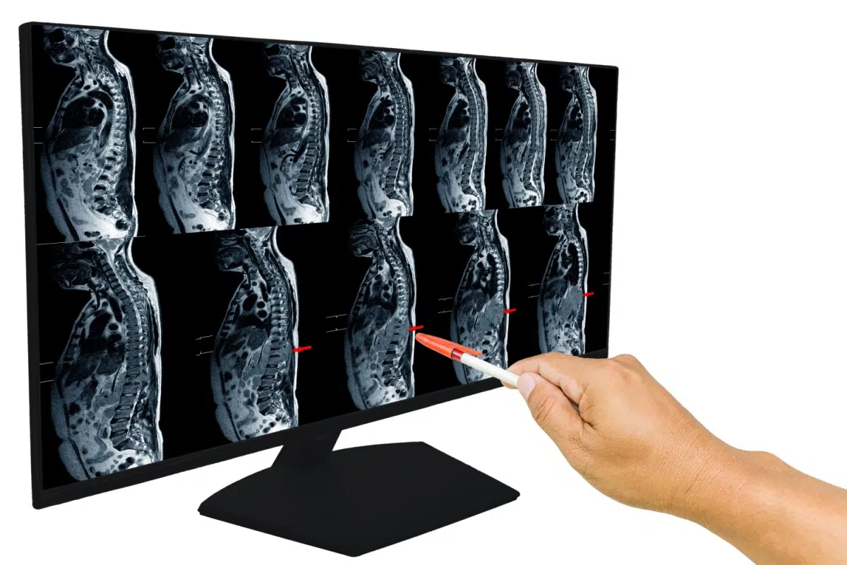 Consult medical chirurg chirurgie spinala istoric medical simptome investigatii imagistice RMN CT Planificare chirurgicala preoperatorie chirugie coloana vertebrala operatie coloana vertebrala minim invaziva
